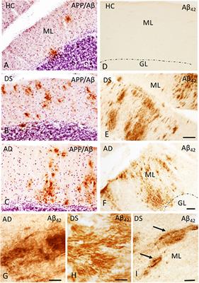 Cerebellar Calcium-Binding Protein and Neurotrophin Receptor Defects in Down Syndrome and Alzheimer's Disease